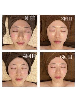 インディバケアの経過写真。掲載画像の表記は左上から術前、2回目、4回目、6回目